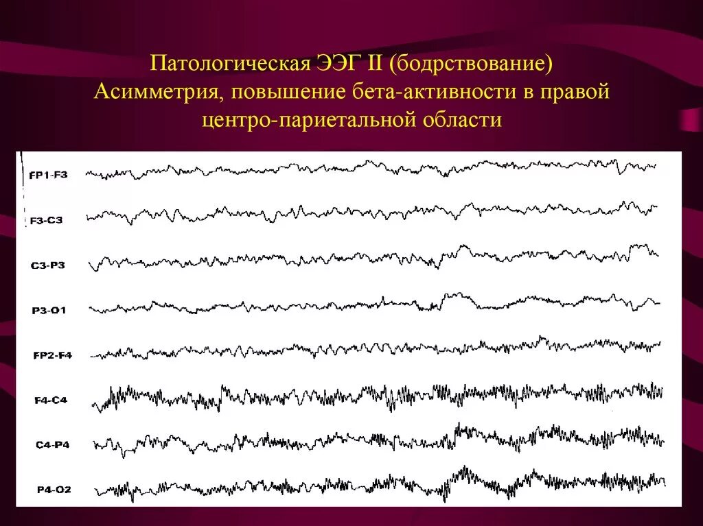 Ээг 9. ЭЭГ головного мозга бодрствование. Патологические ритмы ЭЭГ. ЭЭГ волны патологические. Патологический эпилептиформный паттерн ЭЭГ.