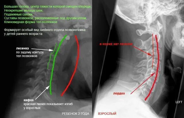 Спинальная нестабильность что это. Гиперлордоз шейного отдела позвоночника рентген. Рентген шейного отдела с функциональными пробами. Функциональная нестабильность шейного отдела позвоночника рентген. Нестабильность с3-с6.