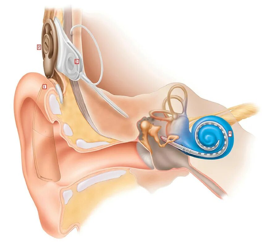 Слуховой аппарат кохлеарный имплант. Аппарат для глухих кохлеарная имплантация. Кохлеарный неврит слухового нерва. Кохлеарный имплант кохлеар. Операция на среднем ухе