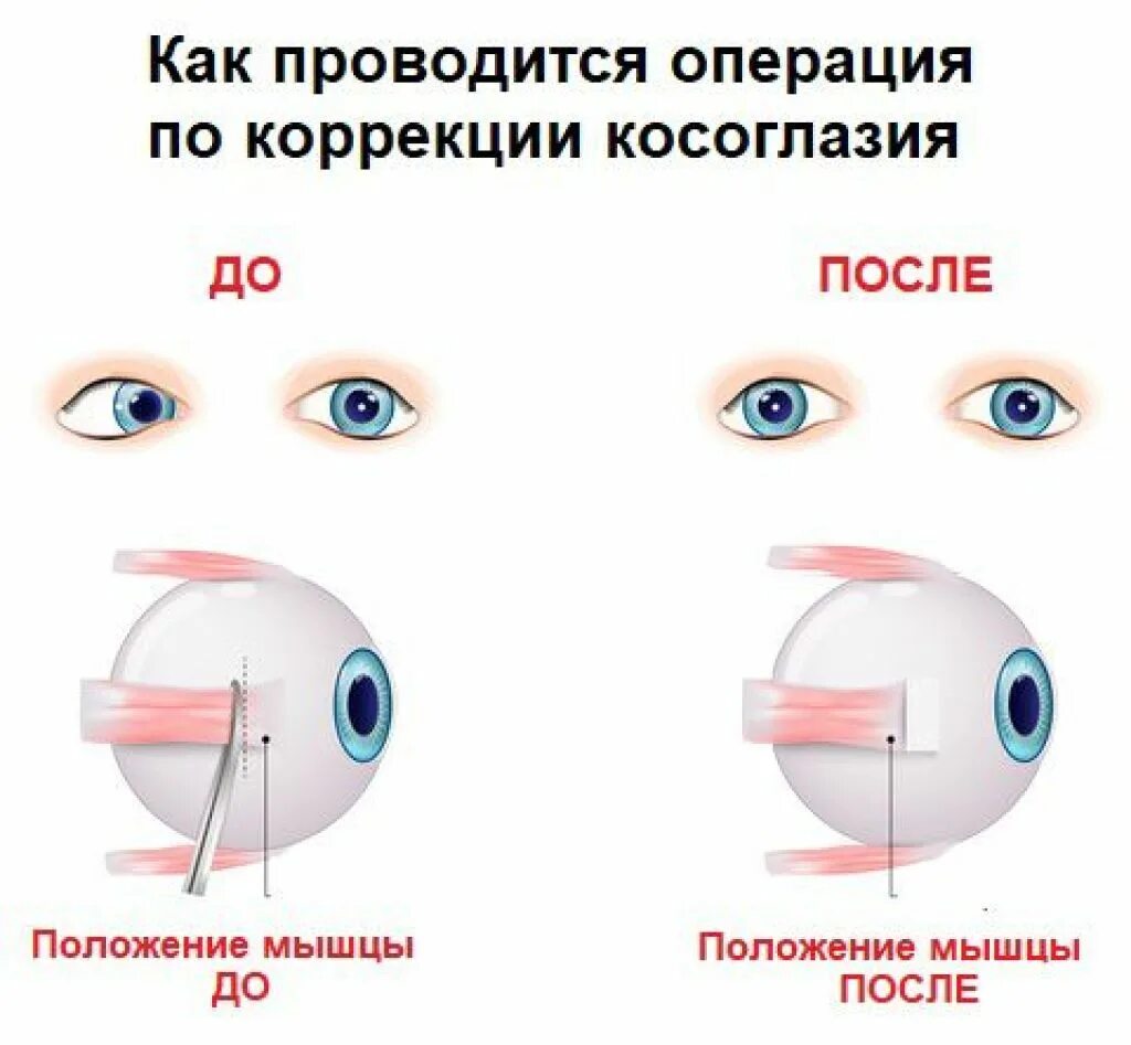 Лечение после операции глаз. Операция по косоглазию. Исправление косоглазия. Операция по коррекции косоглазия.