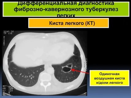 Кавернозный туберкулез кт