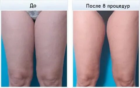 Отек внутреннего бедра