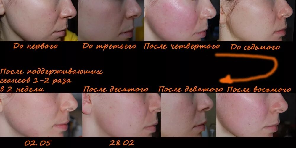 Вакуумный массаж лица - отзывы, фото до и после применения банок