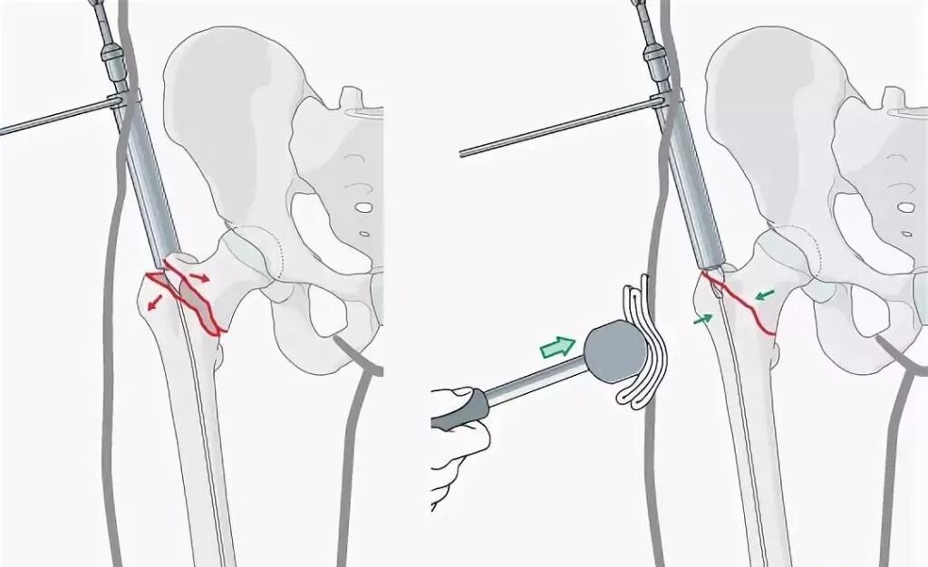 Сломана шейка бедра операция. Операция остеосинтез шейки бедра. Перелом шейки бедра остеосинтез. Туннелизация головки-шейки бедренной кости. Шейка бедра перелом остеосинтез.