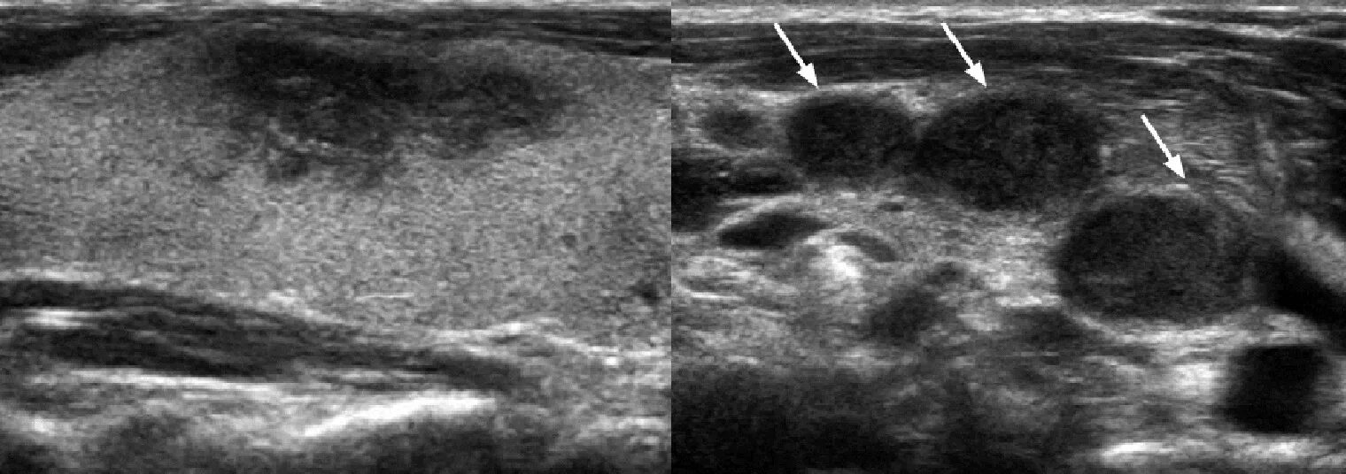 Тиреоидит де Кервена УЗИ. Подострый тиреоидит на УЗИ. Лимфоузлы щитовидной железы на УЗИ. Диффузно узловое образование