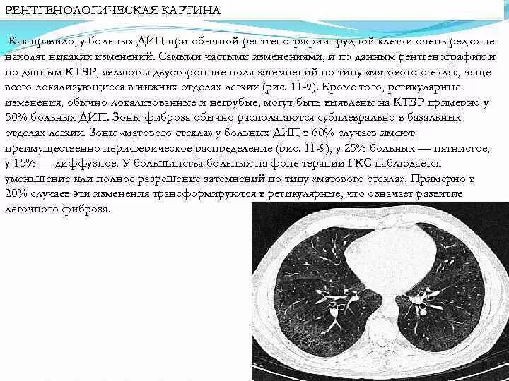 Дерева в почках в легких кт. Идиопатический легочный фиброз кт картина. Ретикулярный фиброз легких кт. Зоны ретикулярных изменений на кт легких.