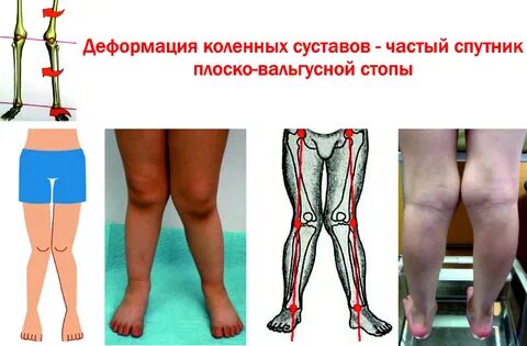 Варусная деформация стопы у взрослых