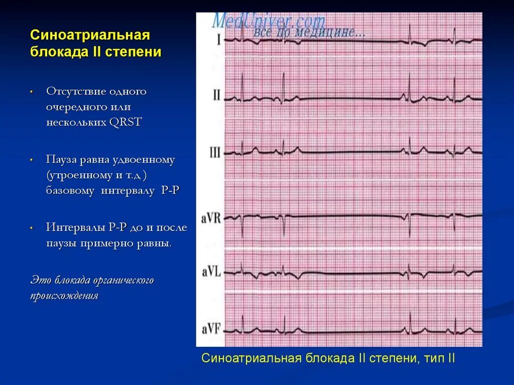Как действует блокада. Синоатриальная блокада 2 степени на ЭКГ. ЭКГ признаки синоатриальной блокады 2 степени. Синоатриальная блокада Мобитц 1 ЭКГ. Синусовая блокада 2 степени ЭКГ.