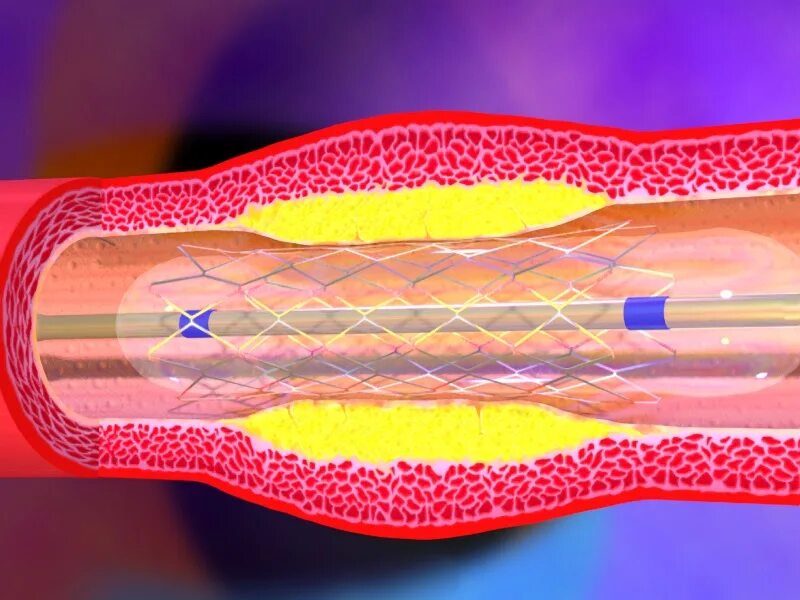 Стент виды. ЧКВ баллонная ангиопластика. ТРАНСЛЮМИНАЛЬНАЯ баллонная ангиопластика. Стентирование коронарных артерий.
