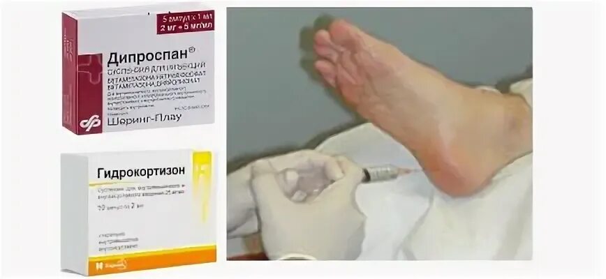Укол при пяточной шпоре в пятку какой. Укол при пяточной шпоре в пятку какой