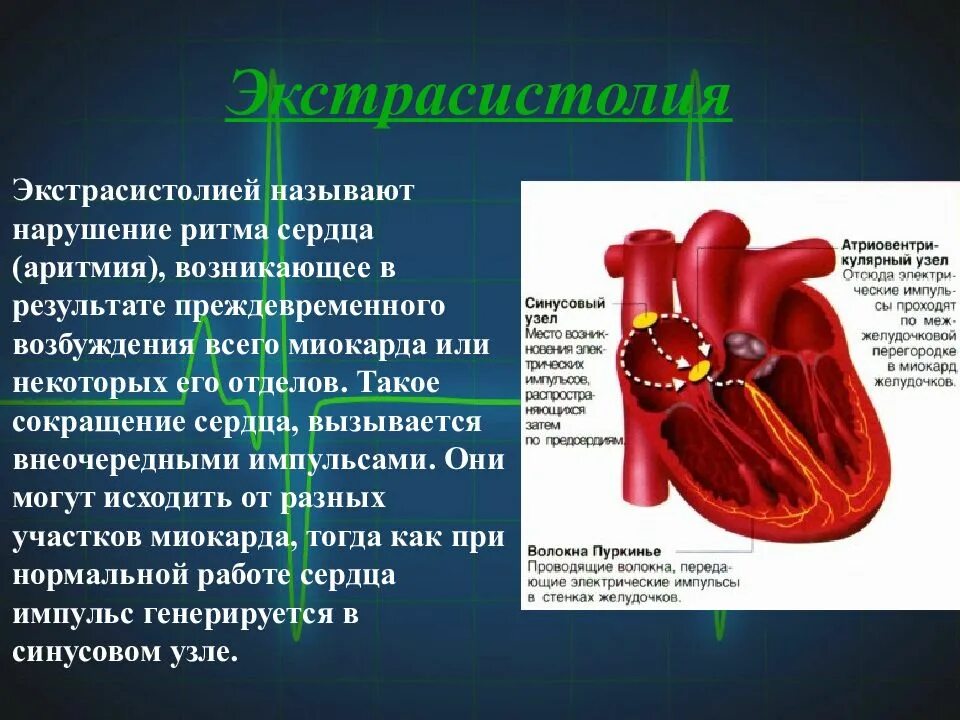 Экстрасистолия сердца симптомы и лечение у взрослых. Желудочковая аритмия сердца. экстрасистолия сердца. желудочковая экстрасистолическая аритмия. нарушение ритма сердца желудочковая экстрасистолия.
