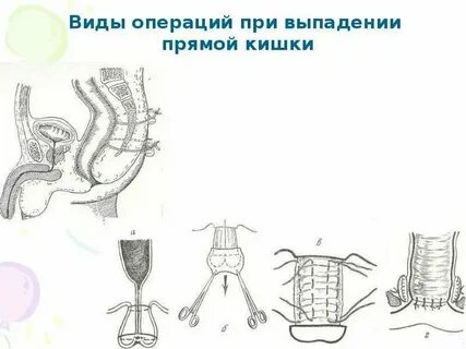 Почему выпала кишка