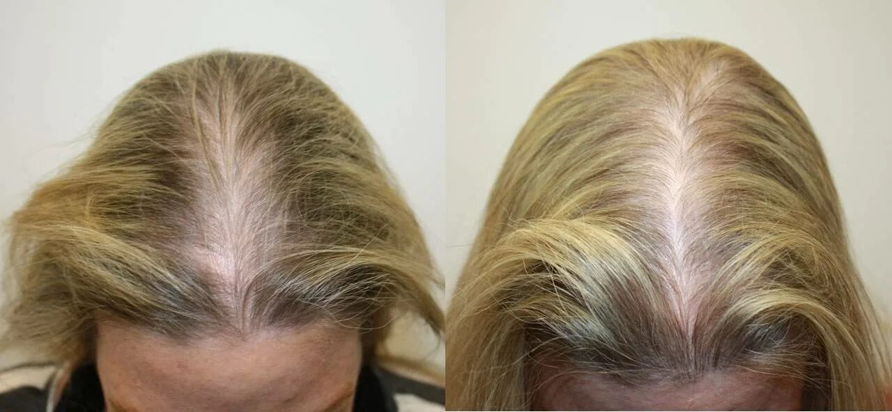 Витамины для роста волос до и после. Луковая маска до и после. Маски при алопеции. Для волос от выпадения и лысин. Витамины для волос до и после.