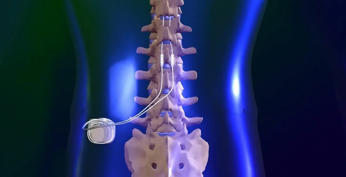 Эпидуральный стимулятор спинного мозга. Нейростимулятор спинного мозга. Нейростимулятор спинного мозга имплантируемый электрод. Нейростимулятор для позвоночника Медтроник.