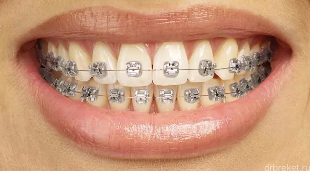 Brackets photo