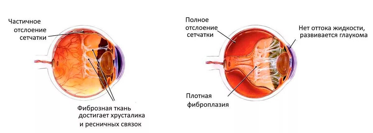 Изображение на сетчатке глаза появляется. Отслойка сетчатки зрение. Отслоение сетчатки глазное дно. Глаз при отслоения сетчатки глаза. Регматогенная отслойка сетчатки глаза.