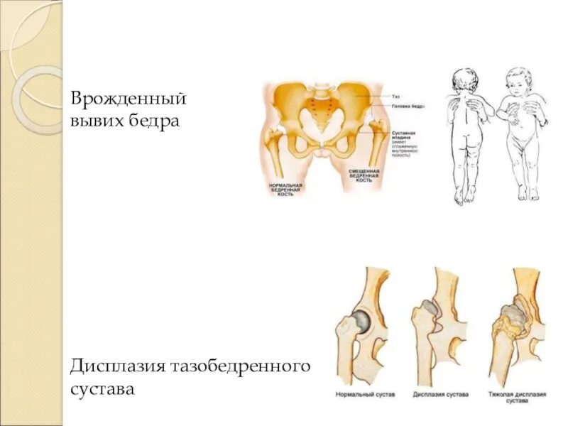 Дисплазия тазобедренных суставов у детей форум. Вродденный вввех тазобедренногосустава. дисплазия вывих тазобедренного сустава. классификация дисплазии вертлужной впадины. врожденный вывих бедренного сустава.