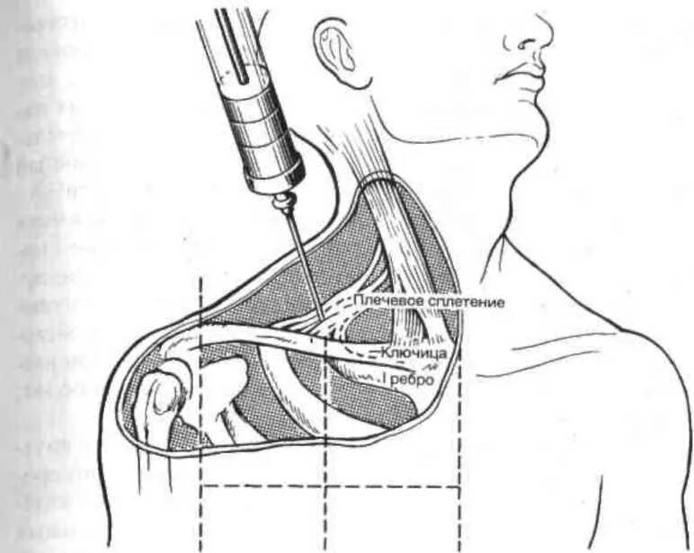 Блокада в шею. Блокада плечевого сплетения по Куленкампфу. Межлестничная блокада плечевого сплетения. Проводниковая анестезия плечевого сплетения по Куленкампфу. Блокада плечевого сплетения по Куленкампфу схема.