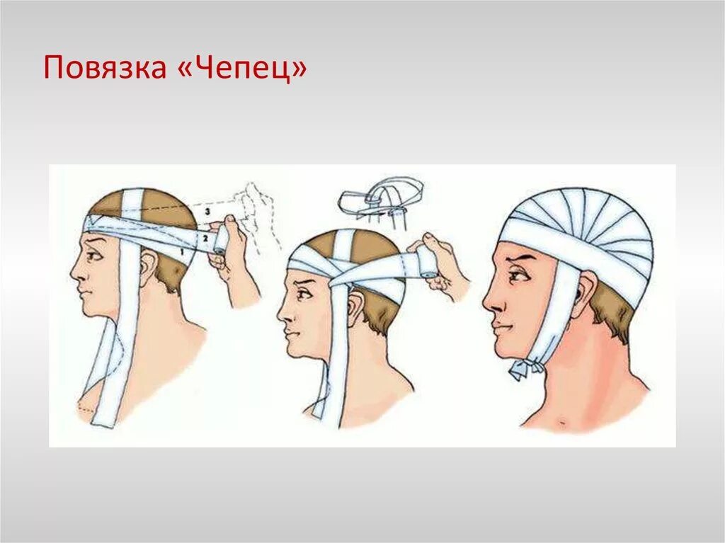 Десмургия чепец. Перевязка чепец техника. Схема наложения повязки чепец. Бинтование чепец. Перевязка головы чепец.