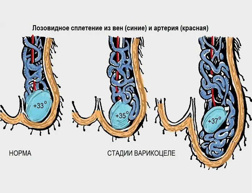 Расширение вен канатика. Варикозное расширение вен семенного канатика III степени. Варикозное расширение вен семенного канатика II степени. Гроздевидное венозное сплетение.