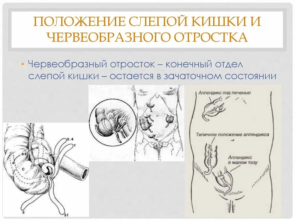 Положения червеобразного отростка. Червеобразный отросток слепой кишки. Положения расположения червеобразного отростка. Высокое расположение червеобразного отростка. Боль в слепой кишке