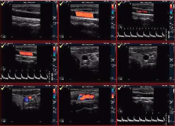 УЗИ УЗДГ брахиоцефальных сосудов. Ультразвуковая допплерография сосудов шеи. Ультразвуковое дуплексное сканирование сосудов шеи. Ультразвуковая допплерография сосудов головного мозга. Бцс что это за обследование