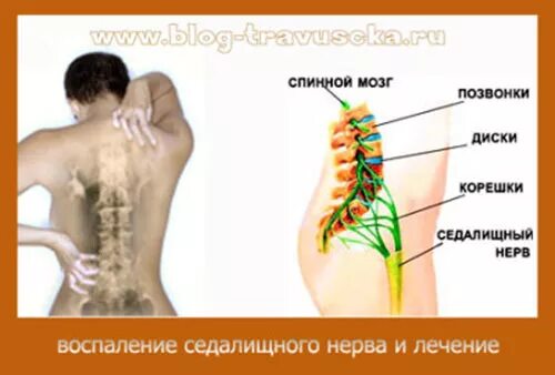 Можно ли греть при защемлении. Седалищный нерв от позвоночника. Защемление седалищного нерва в спине. Защемило нерв в пояснице.