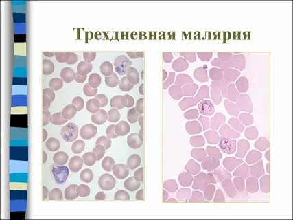 Трехдневная малярия
