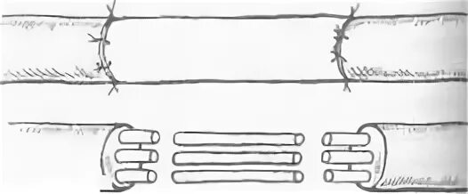 Пластика нервных стволов. Методика сшивания нерва схема. Трансплрнтант ствола нерва. Сшивание нерва латынь