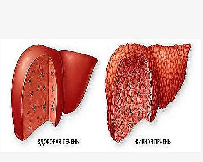 Жировая печень что это значит. Жировой гепатоз печени. Ожирение печени гепатоз печени. Заболевание печени гепатоз. Печеночный жировой гепатоз.