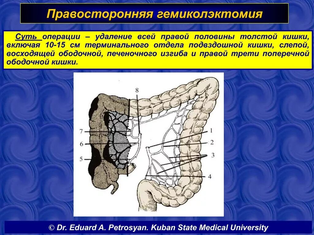 Операция правосторонняя гемиколэктомия. Операция левосторонняя гемиколэктомия. Правосторонняя и левосторонняя гемиколэктомия. Гемиколэктомия ободочной кишки.