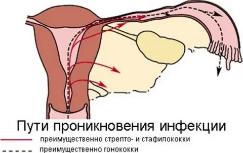 Гнойные придатки