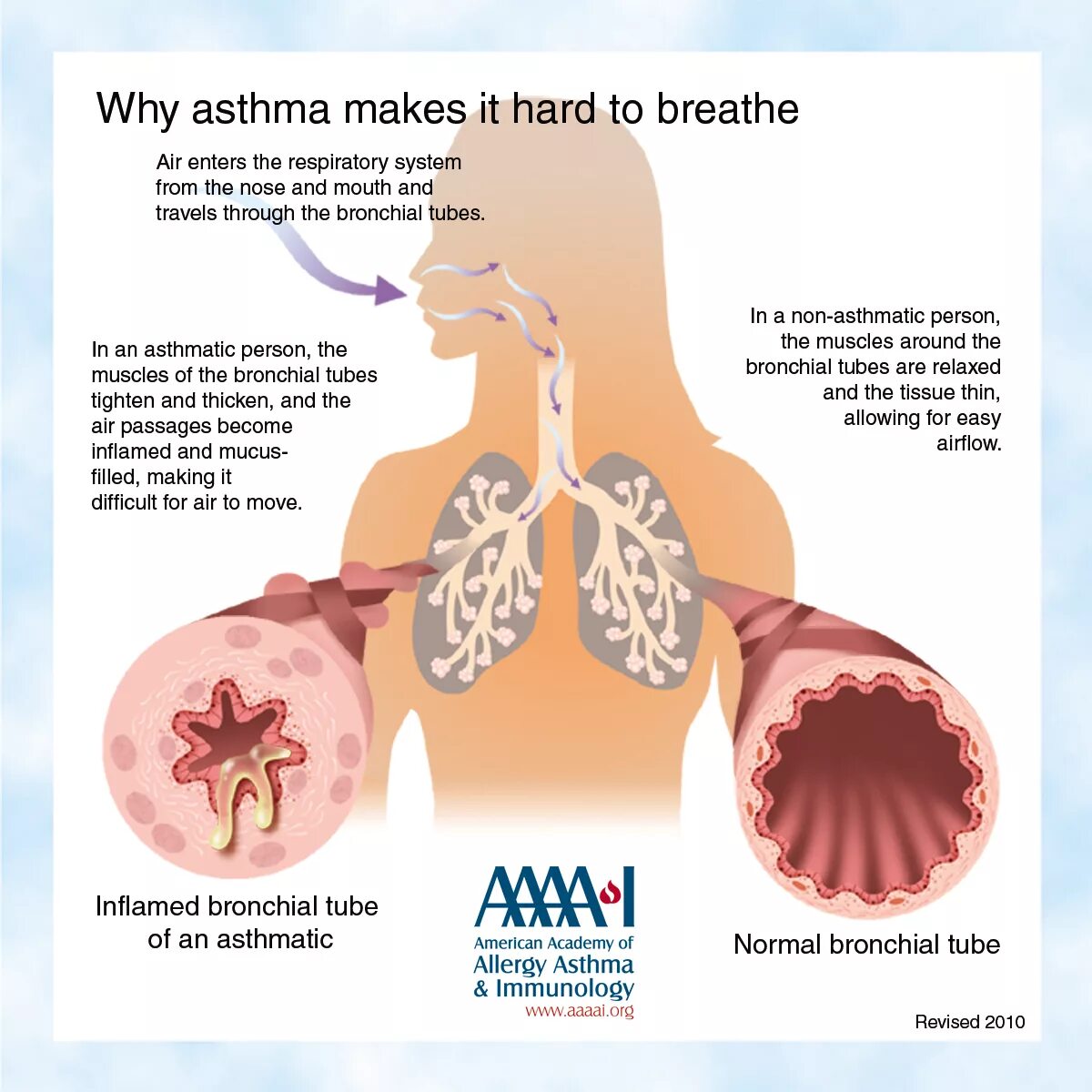 Почему ба. Бронхи больного бронхиальной астмой. Болезнь бронхиальная астма. Бронхиальная астма картинки. Астма легкие.