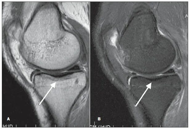 Деформирующий артроз коленного сустава мрт. Артроз коленного сустава мрт. Артроз коленного сустава на кт. Артроз коленного сустава мрт. Мрт исследование коленного сустава.