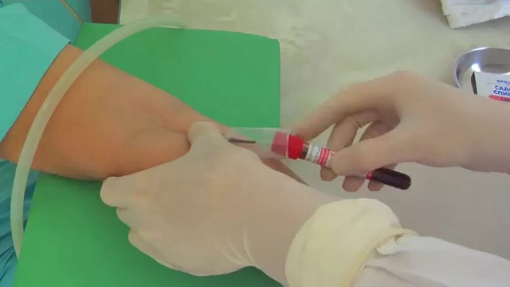 Техника взятия крови из периферической вены. Взятие крови из вены кровопускание. Техника взятия венозной крови. Забор крови из вены бабочкой вакуумной системой. Кровь после взятия анализа