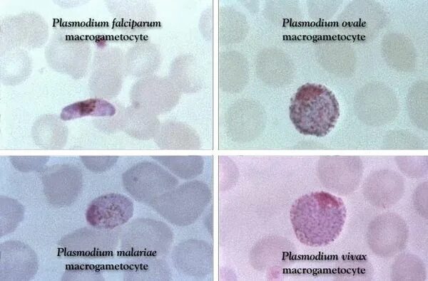Мазок крови при выявлении патологии что это. Малярийный плазмодий мазок толстой крови. Малярия микроскопия тонкий мазок. Плазмодии малярии в толстой капле крови. Микроскопия толстой капли крови.