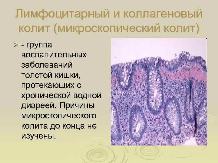 Лимфоидная инфильтрация что это. Коллагенозный и лимфоцитарный колит. Лимфоцитарный колит гистология. Коллагенозный колит гистология. Лимфоцитарный энтерит гистология.