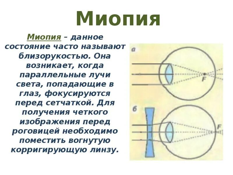 Лучи света перед сетчаткой сетчаткой. Ход лучей в миопическом глазу. Чёткое изображение фокусируется перед сетчаткой. Близорукость лучи света фокусируются. Фокусировка лучей света на внутренней