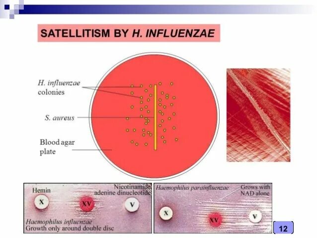 Haemophilus influenzae факторы вирулентности. Haemophilus influenzae норма у взрослых в зеве. H. influenzae. Haemophilus influenzae в носу