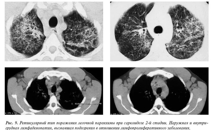 Кт картина саркоидоза. Кт картина саркоидоза легких. Саркоидоз на снимке кт легких. Поражение легких 3
