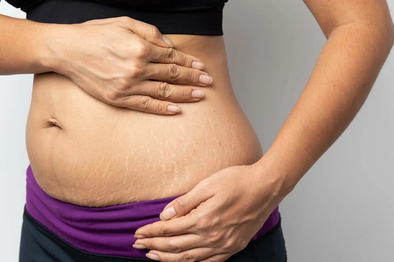 Растяжки stretch marks