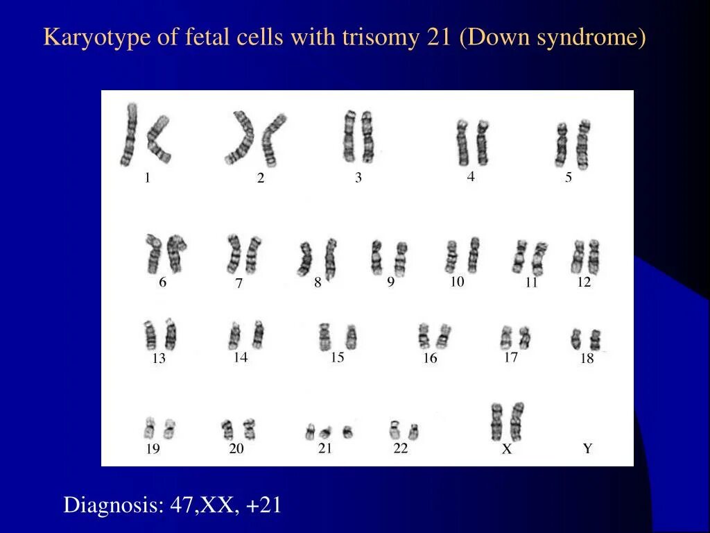 Down Syndrome karyotype. Синдром Дауна кариотип. Синдром Дауна хромосомы. Синдром дауна по наследству