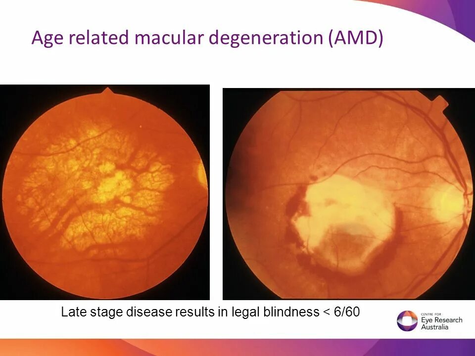 Age related Macular Degeneration Dry form.
