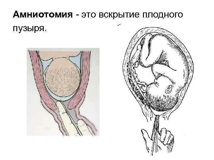 Разрыв плодных. Операция вскрытия плодного пузыря. Прокол пузыря амниотомия плодного. Вскрытие оболочек плодного пузыря. Алгоритм вскрытие оболочек плодного пузыря.