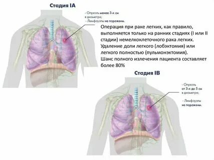 Отец умирает от рака легких