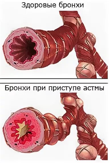 При астме затруднен. При бронхиальной астме затруднен. бронхиальная астма затруднен вдох или выдох. при бронхиальной астме затруднен вдох или выдох. бронхиальная астма затруднен вдох.