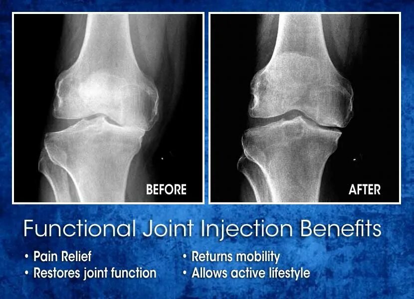 Joint function. Joint pain. a painful injection in a child&#039;s buttock.