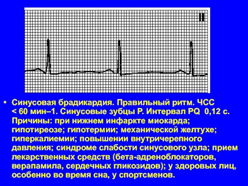 Синусовая брадикардия сердца у подростка. Синусовая брадикардия сердца. экг при брадикардии. синусовая брадикардия возникает при. синусовая брадикардия чсс.