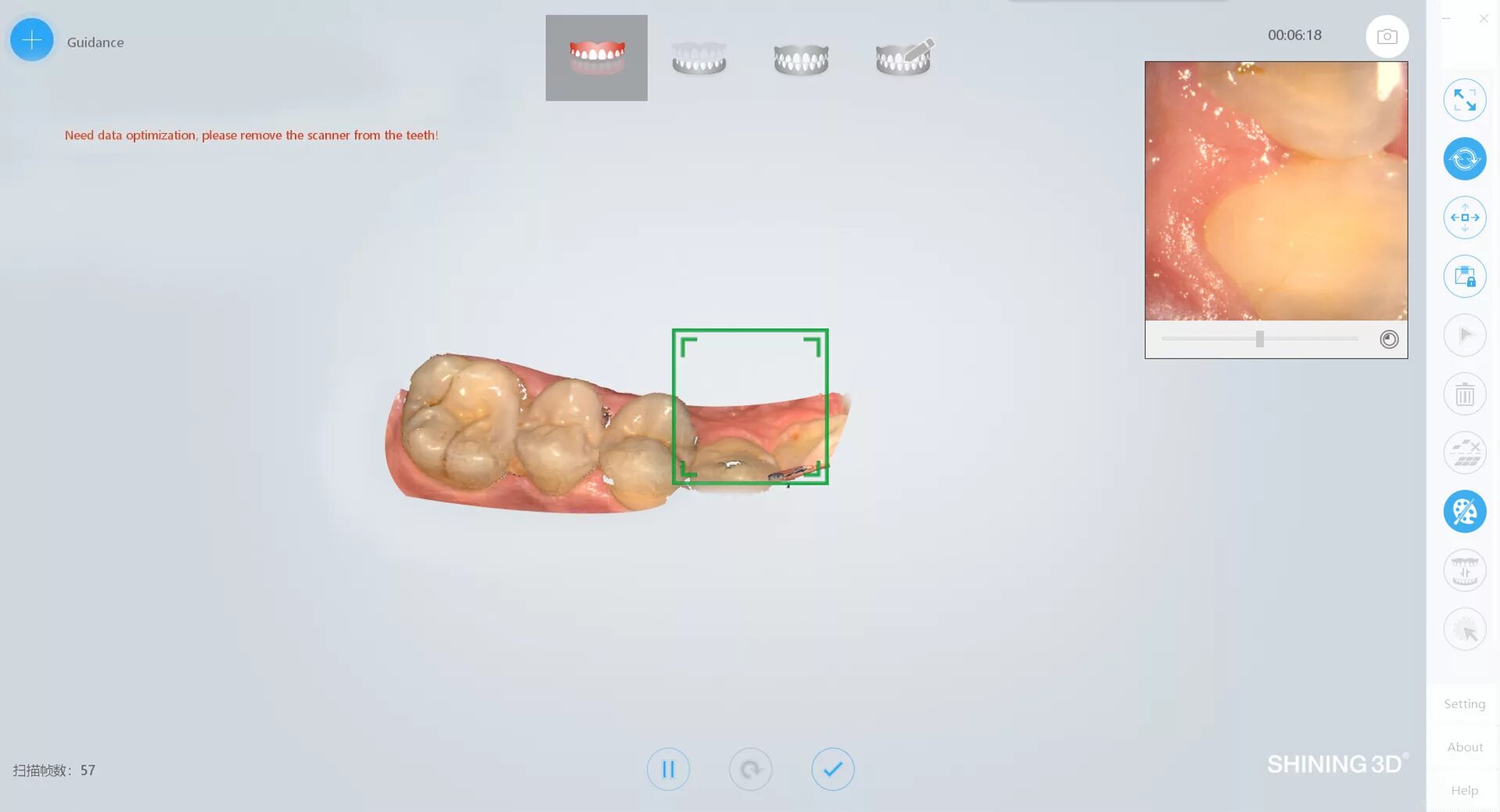 Интраоральный сканер shining 3d aoralscan. Интраоральный сканер shining3d. aoralscan 3. shining 3d сканер стоматологический. интраоральный 3d сканер shining 3d aoralscan 3.