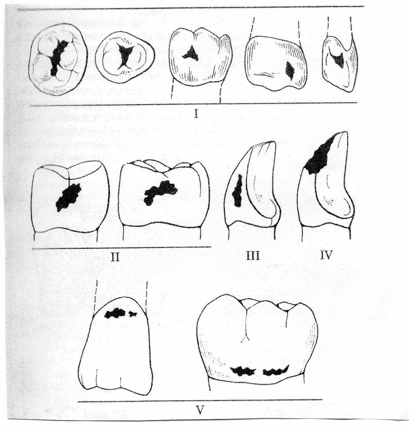 Классы полости рта. Классификация кариозных полостей по локализации. Классификация Блэка кариес. Классификация кариозных полостей по Блэку. Классификациях кариеса и кариозных полостей..